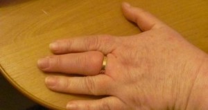 Кольцо на отекшем пальце