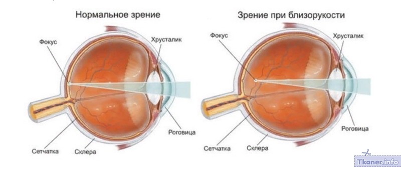 Зрение близорукость