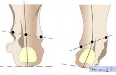 Нормальная и варусная стопа