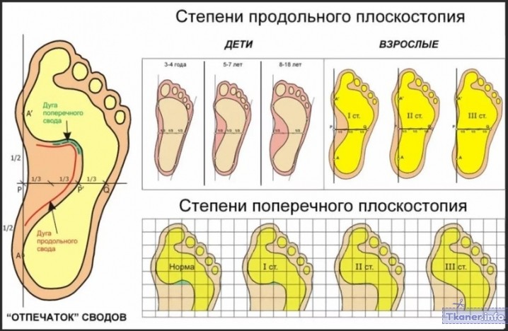 Плоскостопие 4