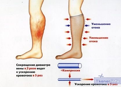 Как работают гетры при варикозе